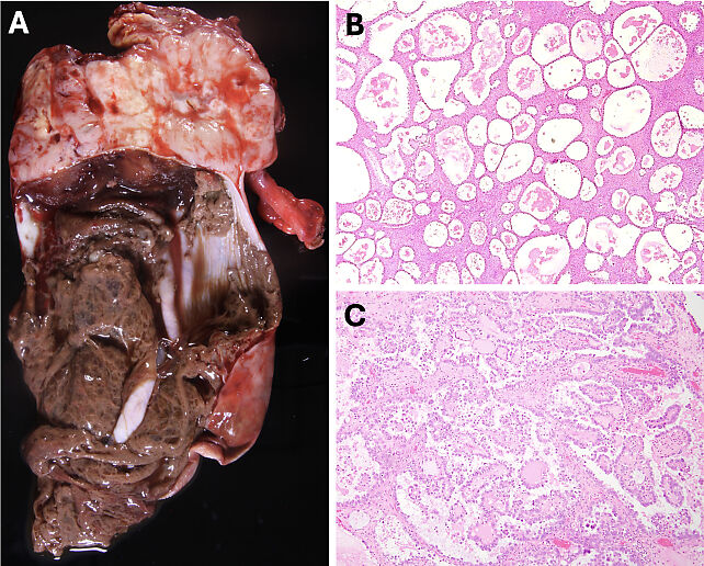 Pathology of Ovarian, Fallopian Tube and Primary Peritoneal